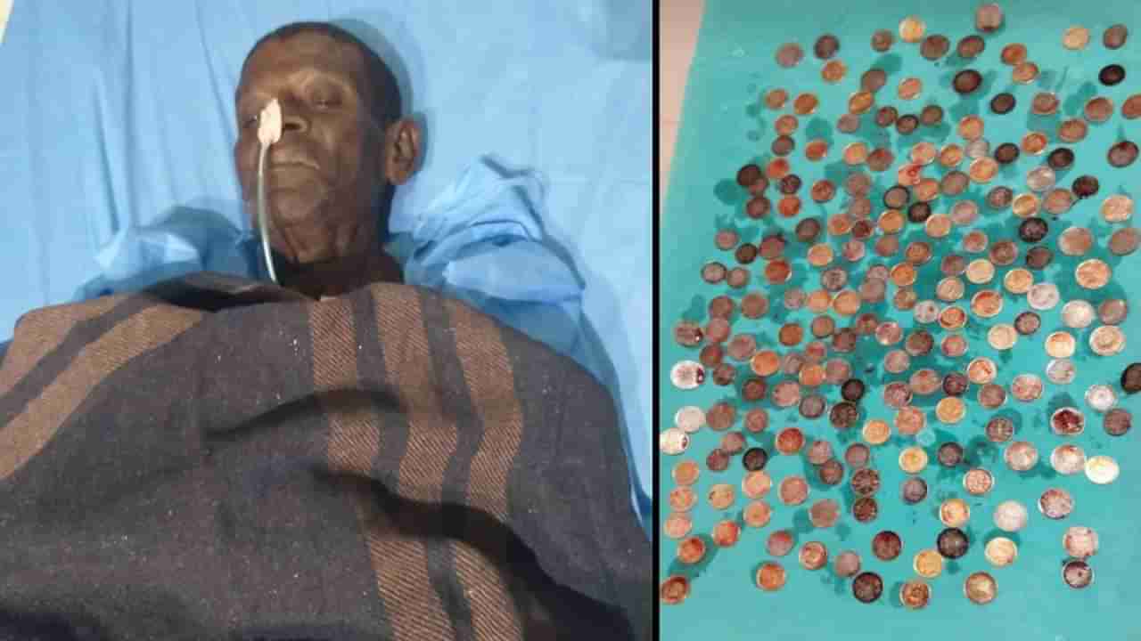 ಬಾಗಲಕೋಟೆ: ವೃದ್ಧನ ಹೊಟ್ಟೆಯಲ್ಲಿದ್ದ 187 ಕಾಯಿನ್ಗಳನ್ನು ಹೊರತೆಗೆದ HSK ಆಸ್ಪತ್ರೆ ವೈದ್ಯರು