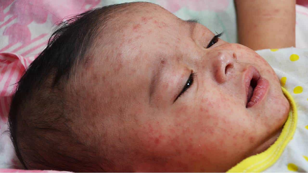 Measles: ಇತ್ತೀಚೆಗೆ ದಡಾರ ಏಕಾಏಕಿ ಲಕ್ಷಾಂತರ ಜೀವಗಳಿಗೆ ಅಪಾಯವನ್ನುಂಟು ಮಾಡುತ್ತಿದೆ Measles: ಇತ್ತೀಚೆಗೆ ದಡಾರ ಏಕಾಏಕಿ ಲಕ್ಷಾಂತರ ಜೀವಗಳಿಗೆ ಅಪಾಯವನ್ನುಂಟು ಮಾಡುತ್ತಿದೆ