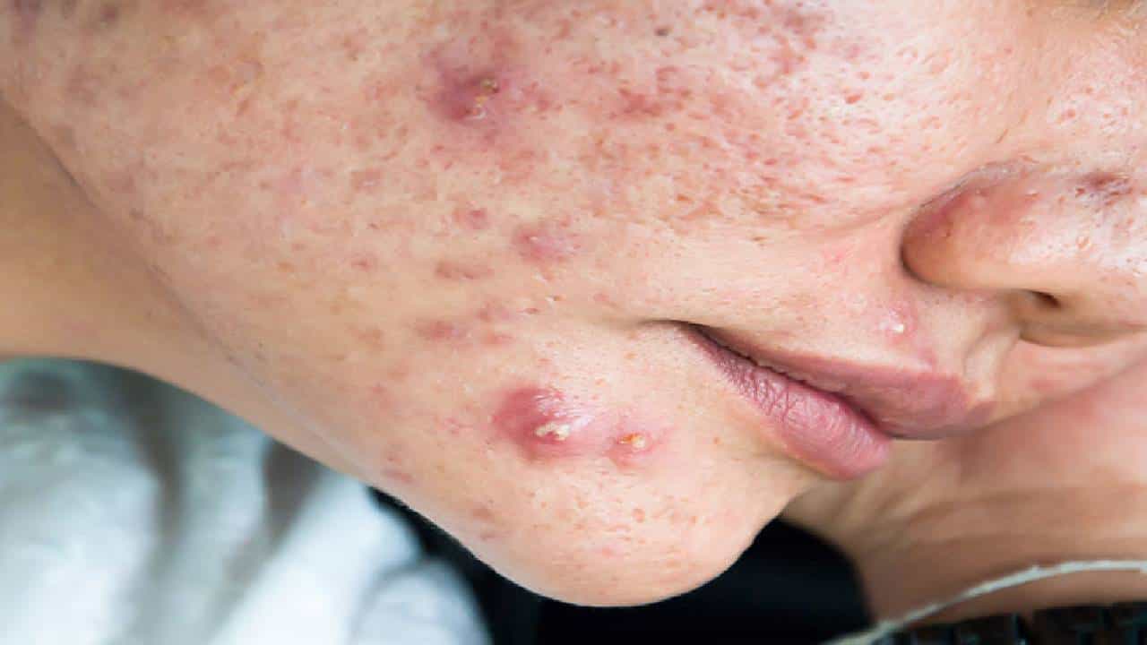 Acne Problem: ನಿಮ್ಮ ಮುಖದಲ್ಲಿ ಸಾಕಷ್ಟು ಮೊಡವೆಗಳಿದ್ದು, ನೀವು ಪ್ರತಿ ದಿನ ಹಾಲು ಕುಡಿಯುತ್ತಿದ್ದರೆ ಎಚ್ಚರ ವಹಿಸಿ. Acne Problem: ನಿಮ್ಮ ಮುಖದಲ್ಲಿ ಸಾಕಷ್ಟು ಮೊಡವೆಗಳಿದ್ದು, ನೀವು ಪ್ರತಿ ದಿನ ಹಾಲು ಕುಡಿಯುತ್ತಿದ್ದರೆ ಎಚ್ಚರ ವಹಿಸಿ.