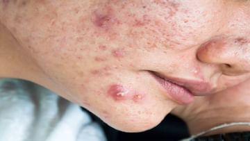 Acne Problem: ನಿಮ್ಮ ಮುಖದಲ್ಲಿ ಸಾಕಷ್ಟು ಮೊಡವೆಗಳಿದ್ದು, ನೀವು ಪ್ರತಿ ದಿನ ಹಾಲು ಕುಡಿಯುತ್ತಿದ್ದರೆ ಎಚ್ಚರ ವಹಿಸಿ.