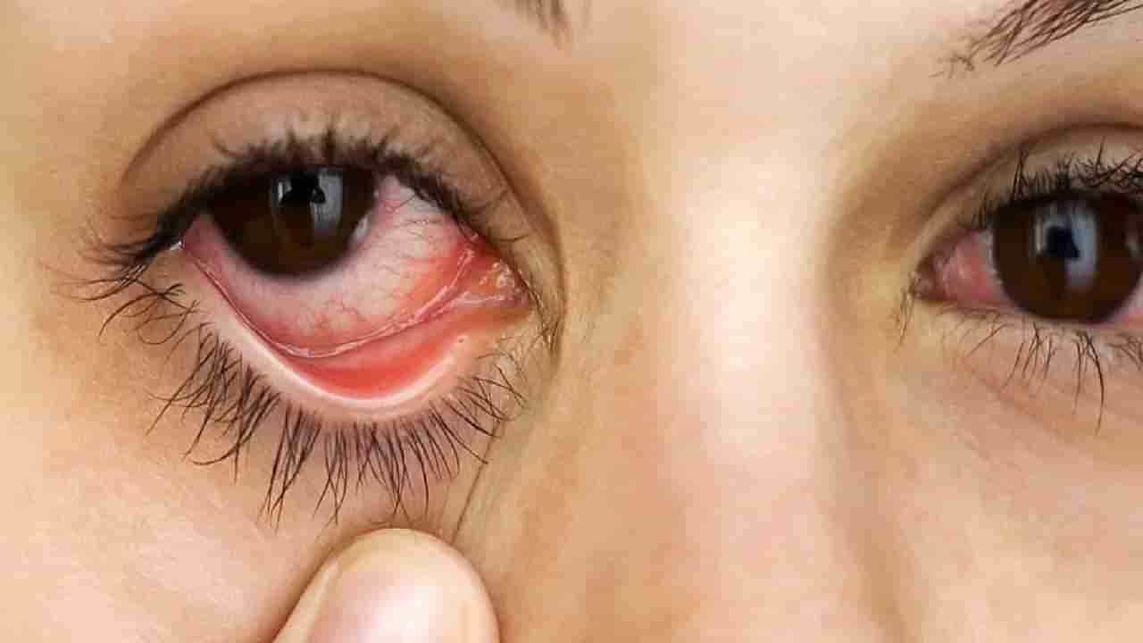 Dry Eye Syndrome: ಕಣ್ಣುಗಳು ಏಕೆ ಒಣಗುತ್ತವೆ? ಈ ಕಾರಣಗಳಿರಬಹುದು