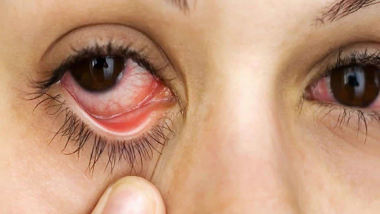 Dry Eye Syndrome: ಕಣ್ಣುಗಳು ಏಕೆ ಒಣಗುತ್ತವೆ? ಈ ಕಾರಣಗಳಿರಬಹುದು Dry Eye Syndrome: ಕಣ್ಣುಗಳು ಏಕೆ ಒಣಗುತ್ತವೆ? ಈ ಕಾರಣಗಳಿರಬಹುದು