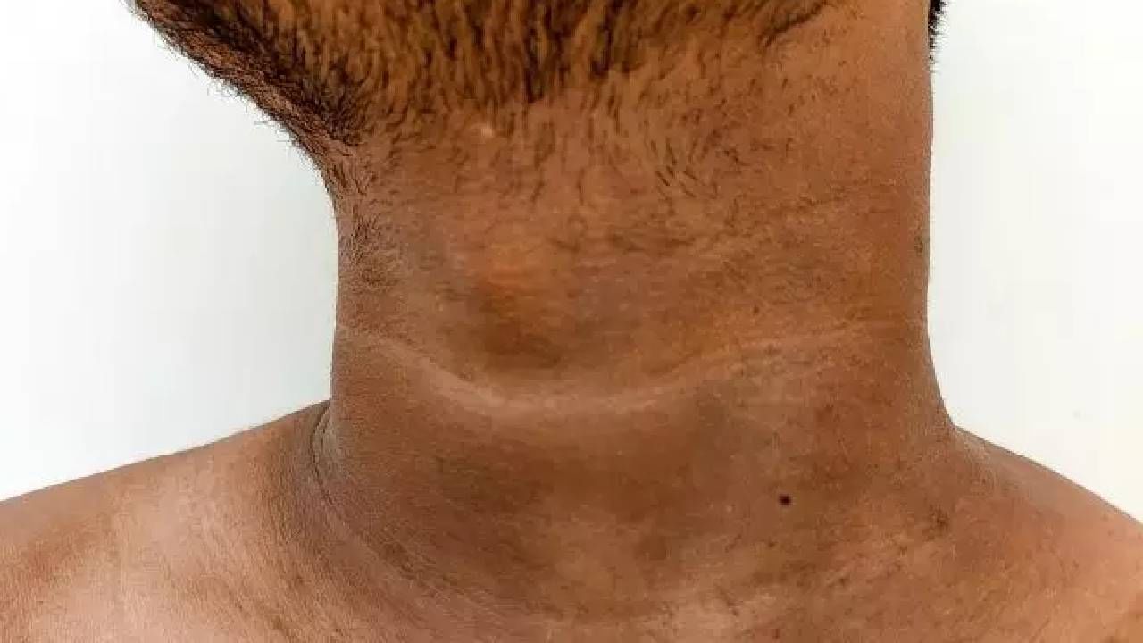 Dark Neck: ಕುತ್ತಿಗೆ ಸುತ್ತ ಕಪ್ಪು ಕಲೆ ಇದೆಯೇ? ಅದನ್ನು ಹೋಗಲಾಡಿಸಲು ಇಲ್ಲಿವೆ ಸರಳ ಸಲಹೆಗಳು Dark Neck: ಕುತ್ತಿಗೆ ಸುತ್ತ ಕಪ್ಪು ಕಲೆ ಇದೆಯೇ? ಅದನ್ನು ಹೋಗಲಾಡಿಸಲು ಇಲ್ಲಿವೆ ಸರಳ ಸಲಹೆಗಳು