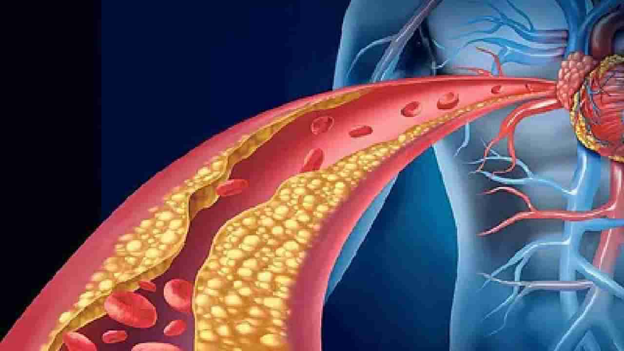 Cholesterol: ನಿಮ್ಮ ಅಪಧಮನಿಗಳಲ್ಲಿ ಕೊಬ್ಬು ಸಂಗ್ರಹವಾದಾಗ ಈ ಲಕ್ಷಣಗಳು ಮೊದಲು ಗೋಚರಿಸಬಹುದು