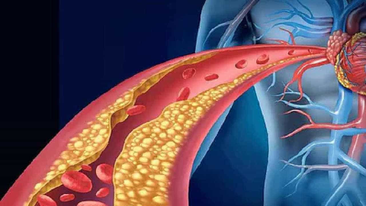 Cholesterol: ನಿಮ್ಮ ಅಪಧಮನಿಗಳಲ್ಲಿ ಕೊಬ್ಬು ಸಂಗ್ರಹವಾದಾಗ ಈ ಲಕ್ಷಣಗಳು ಮೊದಲು ಗೋಚರಿಸಬಹುದು Cholesterol: ನಿಮ್ಮ ಅಪಧಮನಿಗಳಲ್ಲಿ ಕೊಬ್ಬು ಸಂಗ್ರಹವಾದಾಗ ಈ ಲಕ್ಷಣಗಳು ಮೊದಲು ಗೋಚರಿಸಬಹುದು