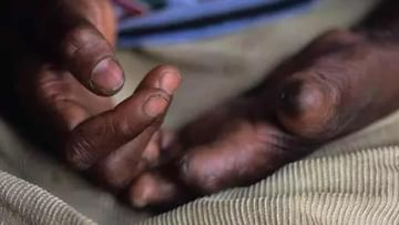 Leprosy: ಕುಷ್ಠರೋಗದ ಬ್ಯಾಕ್ಟೀರಿಯಾವು ಕೆಟ್ಟದ್ದಲ್ಲ, ಒಳ್ಳೆಯದು, ಲಿವರ್​ಗೆ ಸಂಬಂಧಿಸಿದ ಕಾಯಿಲೆಗೆ ಚಿಕಿತ್ಸೆ ನೀಡಲು ಸಹಾಯ ಮಾಡುತ್ತೆ 