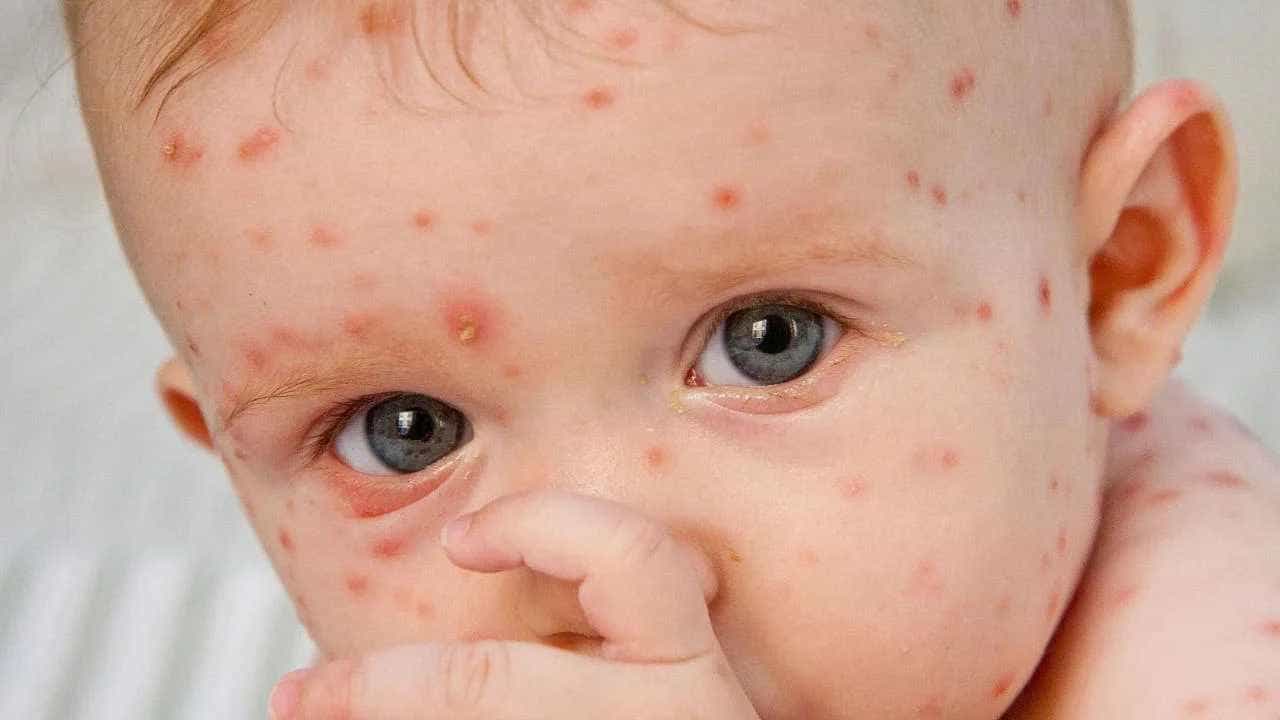 Measles: ಮುಂಬೈನಲ್ಲಿ ದಡಾರ ಉಲ್ಬಣ: 1 ವರ್ಷದ ಮಗು ಸೇರಿ ವರ್ಷದಲ್ಲಿ 10 ಮಕ್ಕಳು ಸಾವು Measles: ಮುಂಬೈನಲ್ಲಿ ದಡಾರ ಉಲ್ಬಣ: 1 ವರ್ಷದ ಮಗು ಸೇರಿ ವರ್ಷದಲ್ಲಿ 10 ಮಕ್ಕಳು ಸಾವು