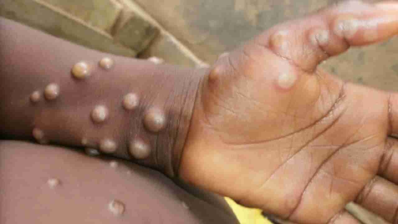 WHO: ಮಂಕಿಪಾಕ್ಸ್​ಗೆ mpox ಎಂದು ಮರುನಾಮಕರಣ ಮಾಡಿದ ವಿಶ್ವ ಆರೋಗ್ಯ ಸಂಸ್ಥೆ