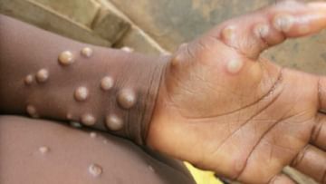 WHO: ಮಂಕಿಪಾಕ್ಸ್​ಗೆ 'mpox' ಎಂದು ಮರುನಾಮಕರಣ ಮಾಡಿದ ವಿಶ್ವ ಆರೋಗ್ಯ ಸಂಸ್ಥೆ
