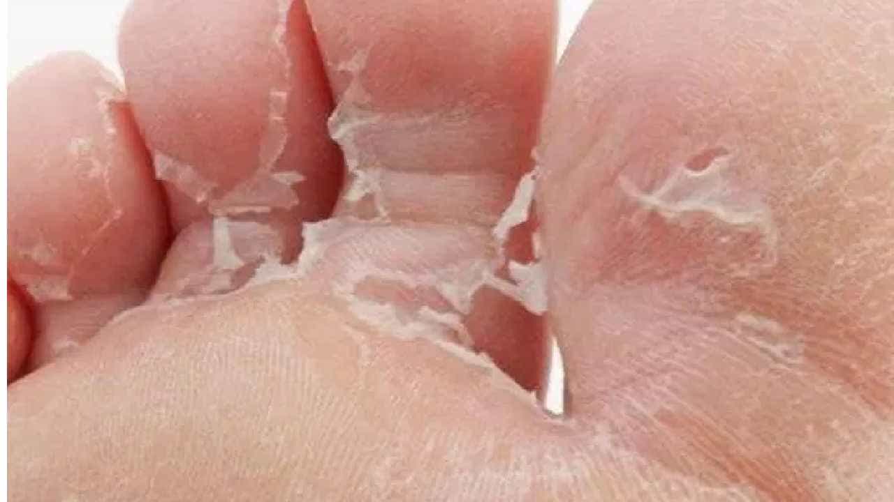 Skin Peeling: ಕೈ-ಕಾಲು ಚರ್ಮದ ಸಿಪ್ಪೆ ಸುಲಿಯುತ್ತಿದೆಯೇ? ಕಾರಣಗಳೇನು, ಕಡಿಮೆ ಮಾಡುವುದು ಹೇಗೆ?