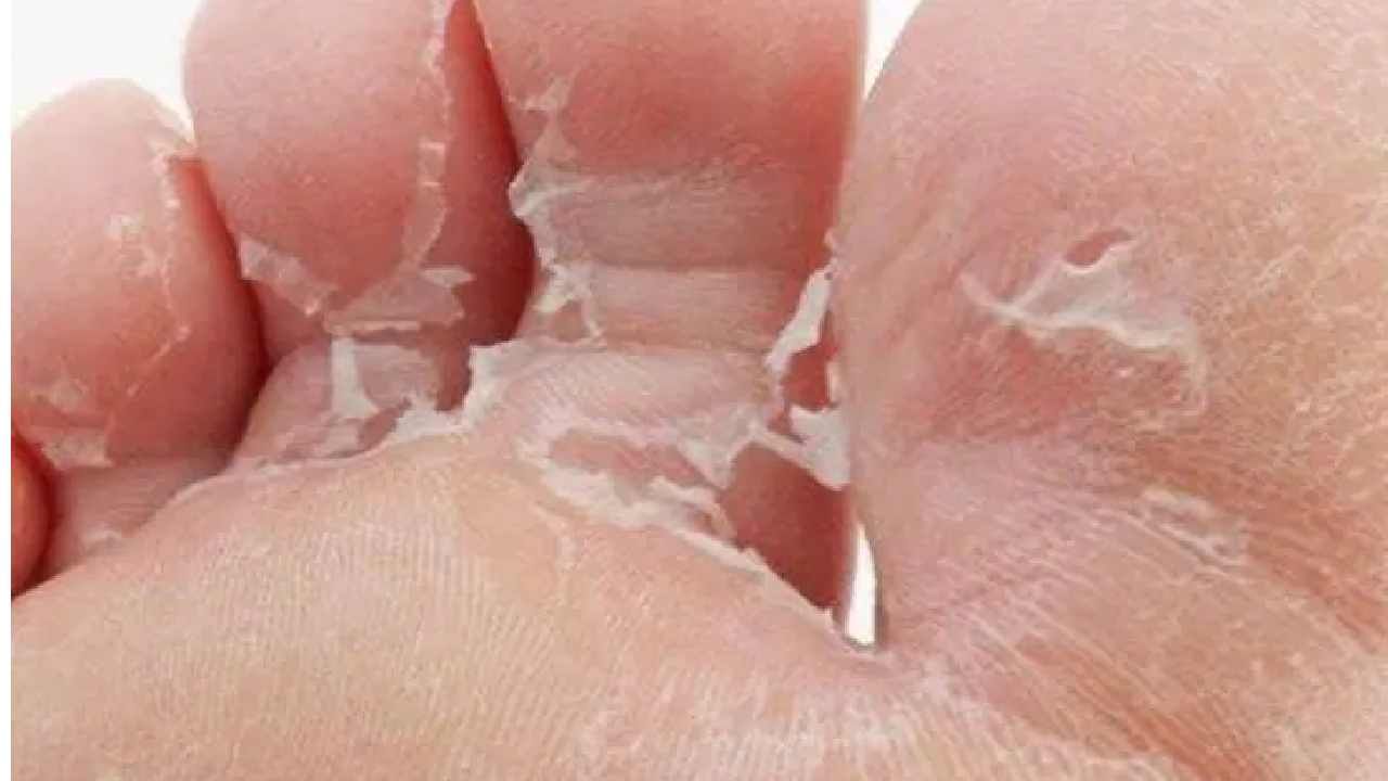 Skin Peeling: ಕೈ-ಕಾಲು ಚರ್ಮದ ಸಿಪ್ಪೆ ಸುಲಿಯುತ್ತಿದೆಯೇ? ಕಾರಣಗಳೇನು, ಕಡಿಮೆ ಮಾಡುವುದು ಹೇಗೆ? Skin Peeling: ಕೈ-ಕಾಲು ಚರ್ಮದ ಸಿಪ್ಪೆ ಸುಲಿಯುತ್ತಿದೆಯೇ? ಕಾರಣಗಳೇನು, ಕಡಿಮೆ ಮಾಡುವುದು ಹೇಗೆ?