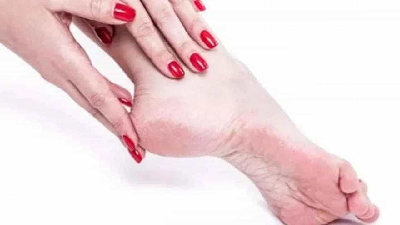 Cracked Heels: ಚಳಿಗಾಲದಲ್ಲಿ ಒಡೆದ ಹಿಮ್ಮಡಿಗಳ ಚಿಂತೆಯೇ? ಪಾದಗಳನ್ನು ಕೋಮಲವಾಗಿರುವಂತೆ ನೋಡಿಕೊಳ್ಳುವುದು ಹೇಗೆ? Cracked Heels: ಚಳಿಗಾಲದಲ್ಲಿ ಒಡೆದ ಹಿಮ್ಮಡಿಗಳ ಚಿಂತೆಯೇ? ಪಾದಗಳನ್ನು ಕೋಮಲವಾಗಿರುವಂತೆ ನೋಡಿಕೊಳ್ಳುವುದು ಹೇಗೆ?