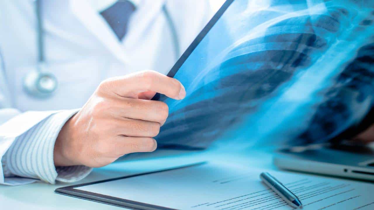 Small Cell Lung Cancer: ಕೊರೊನಾ ಬಳಿಕ ಧೂಮಪಾನಿಗಳನ್ನು ಕಾಡುತ್ತಿದೆ ಶ್ವಾಸಕೋಶದ ಕ್ಯಾನ್ಸರ್ Small Cell Lung Cancer: ಕೊರೊನಾ ಬಳಿಕ ಧೂಮಪಾನಿಗಳನ್ನು ಕಾಡುತ್ತಿದೆ ಶ್ವಾಸಕೋಶದ ಕ್ಯಾನ್ಸರ್