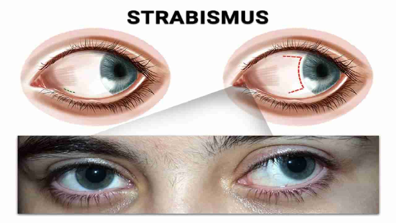 Strabismus: ಸ್ಟ್ರಾಬಿಸ್ಮಸ್ ಎಂದರೇನು? ಈ ಸಮಸ್ಯೆ ಕಂಡುಬರಲು ಕಾರಣವೇನು?