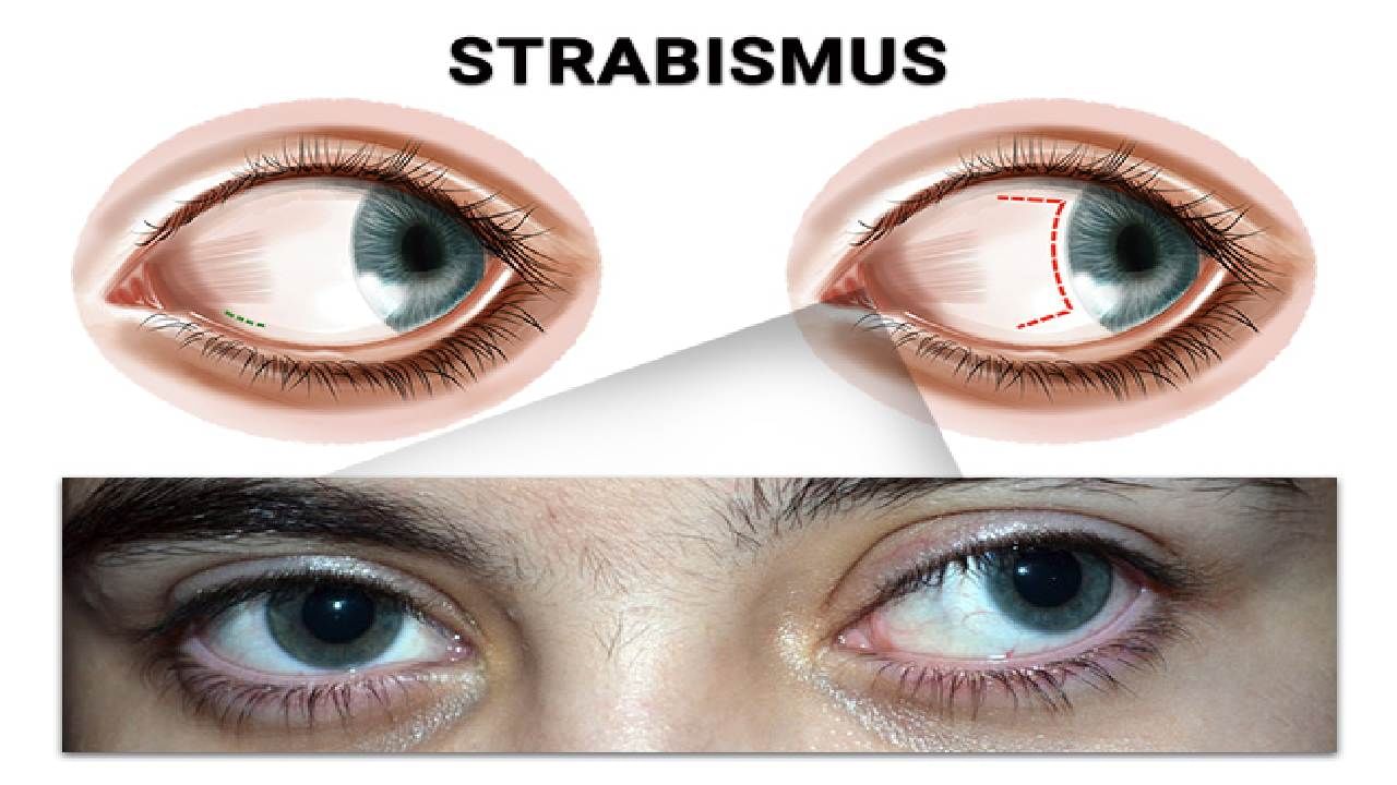 Strabismus: ಸ್ಟ್ರಾಬಿಸ್ಮಸ್ ಎಂದರೇನು? ಈ ಸಮಸ್ಯೆ ಕಂಡುಬರಲು ಕಾರಣವೇನು? Strabismus: ಸ್ಟ್ರಾಬಿಸ್ಮಸ್ ಎಂದರೇನು? ಈ ಸಮಸ್ಯೆ ಕಂಡುಬರಲು ಕಾರಣವೇನು?