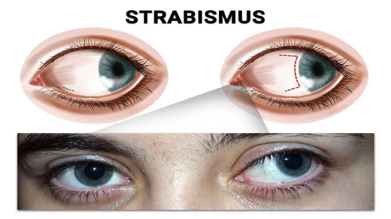 Strabismus: ಸ್ಟ್ರಾಬಿಸ್ಮಸ್ ಎಂದರೇನು? ಈ ಸಮಸ್ಯೆ ಕಂಡುಬರಲು ಕಾರಣವೇನು?