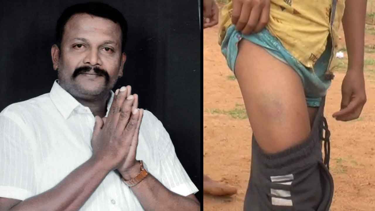 ತುಮಕೂರು: ವಸತಿ ಶಾಲೆ ಮಕ್ಕಳ ಮೇಲೆ ಪಾನಮತ್ತನಿಂದ ಮಾರಣಾಂತಿಕ ಹಲ್ಲೆ: ಚಿಕಿತ್ಸೆ ಕೊಡಿಸದೆ ವಿಷಯ ಮುಚ್ಚಿಟ್ಟ ಆಡಳಿತ ಮಂಡಳಿ ತುಮಕೂರು: ವಸತಿ ಶಾಲೆ ಮಕ್ಕಳ ಮೇಲೆ ಪಾನಮತ್ತನಿಂದ ಮಾರಣಾಂತಿಕ ಹಲ್ಲೆ: ಚಿಕಿತ್ಸೆ ಕೊಡಿಸದೆ ವಿಷಯ ಮುಚ್ಚಿಟ್ಟ ಆಡಳಿತ ಮಂಡಳಿ