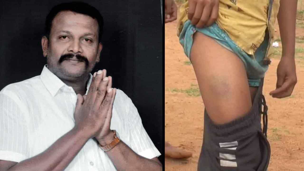 ತುಮಕೂರು: ವಸತಿ ಶಾಲೆ ಮಕ್ಕಳ ಮೇಲೆ ಪಾನಮತ್ತನಿಂದ ಮಾರಣಾಂತಿಕ ಹಲ್ಲೆ: ಚಿಕಿತ್ಸೆ ಕೊಡಿಸದೆ ವಿಷಯ ಮುಚ್ಚಿಟ್ಟ ಆಡಳಿತ ಮಂಡಳಿ ತುಮಕೂರು: ವಸತಿ ಶಾಲೆ ಮಕ್ಕಳ ಮೇಲೆ ಪಾನಮತ್ತನಿಂದ ಮಾರಣಾಂತಿಕ ಹಲ್ಲೆ: ಚಿಕಿತ್ಸೆ ಕೊಡಿಸದೆ ವಿಷಯ ಮುಚ್ಚಿಟ್ಟ ಆಡಳಿತ ಮಂಡಳಿ