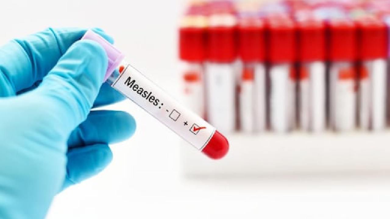 Measles Mayhem: ಮುಂಬೈನಲ್ಲಿ 2 ತಿಂಗಳಲ್ಲಿ 84 ದಡಾರದ ಕೇಸ್ ಪತ್ತೆ, 48 ಗಂಟೆಯಲ್ಲಿ ಮೂರು ಮಕ್ಕಳು ಸಾವು; ಪೋಷಕರಲ್ಲಿ ಹೆಚ್ಚಿದ ಆತಂಕ Measles Mayhem: ಮುಂಬೈನಲ್ಲಿ 2 ತಿಂಗಳಲ್ಲಿ 84 ದಡಾರದ ಕೇಸ್ ಪತ್ತೆ, 48 ಗಂಟೆಯಲ್ಲಿ ಮೂರು ಮಕ್ಕಳು ಸಾವು; ಪೋಷಕರಲ್ಲಿ ಹೆಚ್ಚಿದ ಆತಂಕ