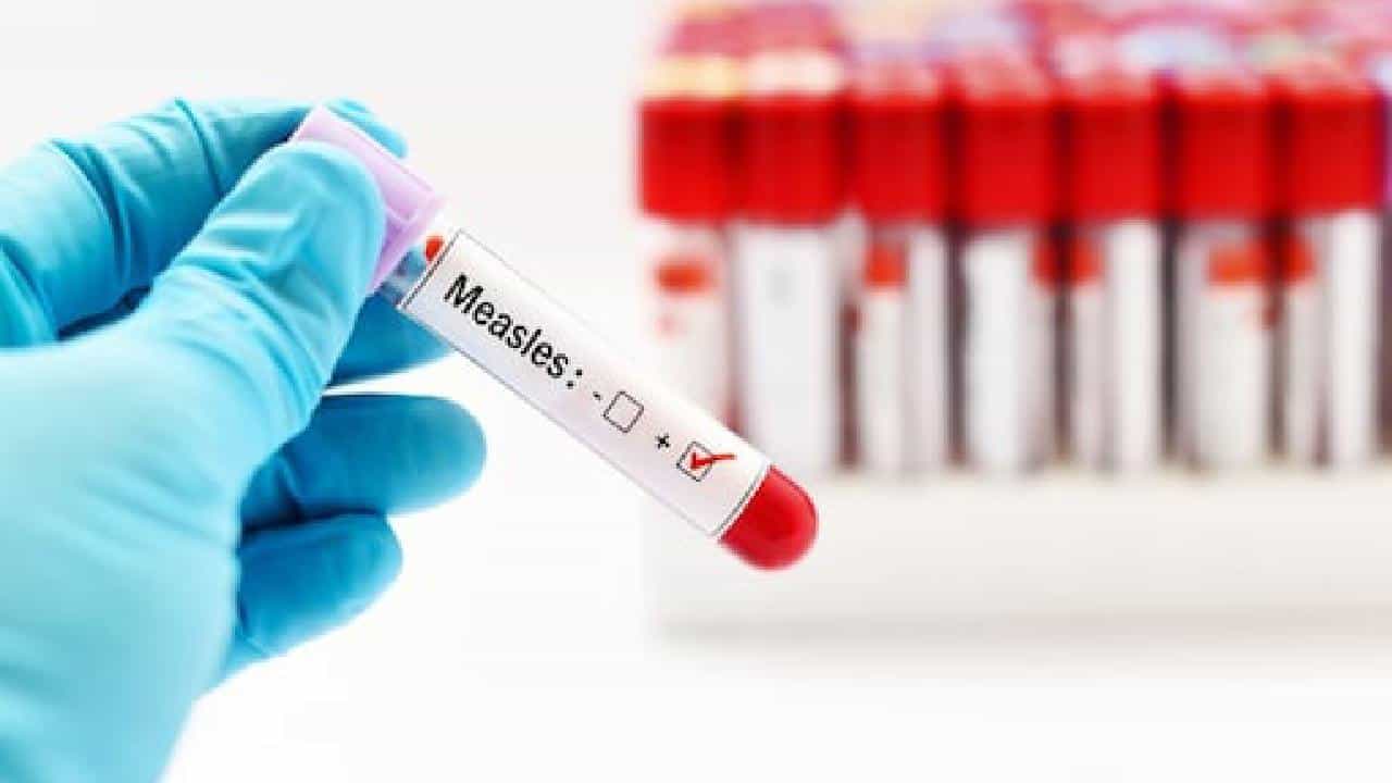 Measles Mayhem: ಮುಂಬೈನಲ್ಲಿ 2 ತಿಂಗಳಲ್ಲಿ 84 ದಡಾರದ ಕೇಸ್ ಪತ್ತೆ, 48 ಗಂಟೆಯಲ್ಲಿ ಮೂರು ಮಕ್ಕಳು ಸಾವು; ಪೋಷಕರಲ್ಲಿ ಹೆಚ್ಚಿದ ಆತಂಕ Measles Mayhem: ಮುಂಬೈನಲ್ಲಿ 2 ತಿಂಗಳಲ್ಲಿ 84 ದಡಾರದ ಕೇಸ್ ಪತ್ತೆ, 48 ಗಂಟೆಯಲ್ಲಿ ಮೂರು ಮಕ್ಕಳು ಸಾವು; ಪೋಷಕರಲ್ಲಿ ಹೆಚ್ಚಿದ ಆತಂಕ