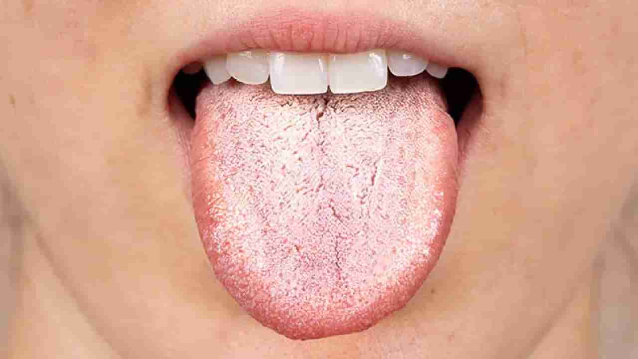 White Tongue: ಬಿಳಿ ನಾಲಿಗೆಯಿಂದ ಈ ಆರೋಗ್ಯದ ಸಮಸ್ಯೆ ಉಂಟಾಗಬಹುದು