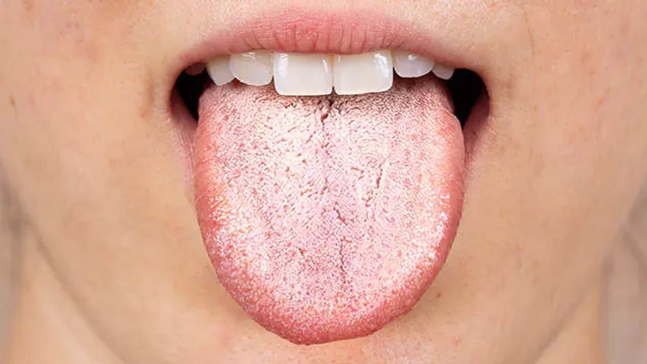 White Tongue: ಬಿಳಿ ನಾಲಿಗೆಯಿಂದ ಈ ಆರೋಗ್ಯದ ಸಮಸ್ಯೆ ಉಂಟಾಗಬಹುದು