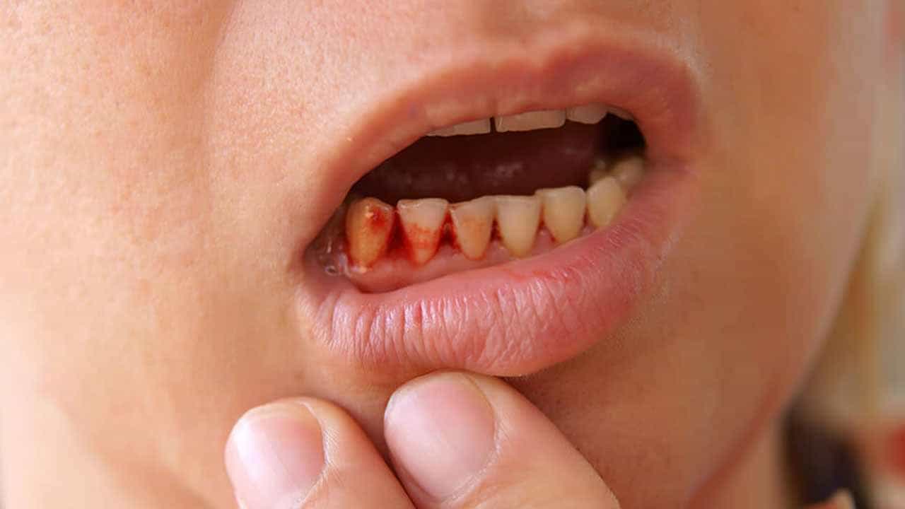 Gum Bleeding: ಒಸಡಿನಿಂದ ರಕ್ತ ಬರುತ್ತಿದೆಯೇ? ಈ 3 ಮನೆಮದ್ದುಗಳನ್ನು ಟ್ರೈ ಮಾಡಿ ಕೂಡಲೇ ಗುಣವಾಗುತ್ತೆ Gum Bleeding: ಒಸಡಿನಿಂದ ರಕ್ತ ಬರುತ್ತಿದೆಯೇ? ಈ 3 ಮನೆಮದ್ದುಗಳನ್ನು ಟ್ರೈ ಮಾಡಿ ಕೂಡಲೇ ಗುಣವಾಗುತ್ತೆ