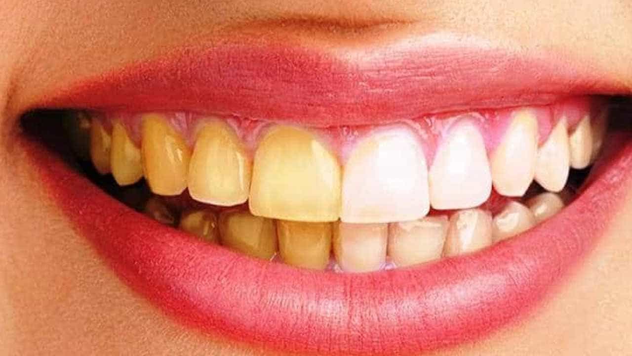 Teeth Whitening Tips: ಹಳದಿ ಹಲ್ಲುಗಳಿಂದಾಗಿ ನಗಲು ಮುಜುಗರ ಪಡುತ್ತಿದ್ದೀರಾ, ಹಲ್ಲುಗಳನ್ನು ಬೆಳ್ಳಗಾಗಿಸುವ ಕೆಲವು ಟಿಪ್ಸ್ಗಳು ನಿಮಗಾಗಿ Teeth Whitening Tips: ಹಳದಿ ಹಲ್ಲುಗಳಿಂದಾಗಿ ನಗಲು ಮುಜುಗರ ಪಡುತ್ತಿದ್ದೀರಾ, ಹಲ್ಲುಗಳನ್ನು ಬೆಳ್ಳಗಾಗಿಸುವ ಕೆಲವು ಟಿಪ್ಸ್ಗಳು ನಿಮಗಾಗಿ