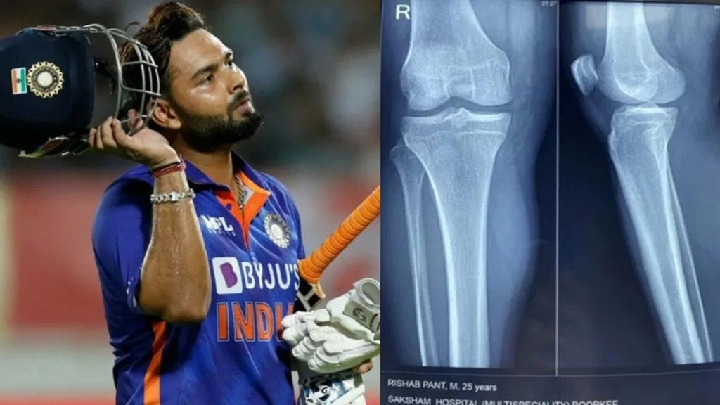 Rishabh Pant accident Rishabh Pants Leg X Ray report and bcci give statement on rishabh pant health