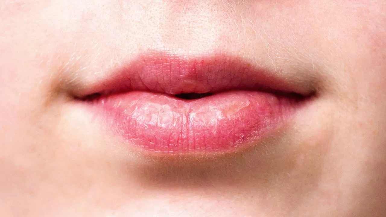 Chapped Lips: ತುಟಿಗಳು ಒಡೆಯಲು ಕಡಿಮೆ ನೀರು ಕುಡಿಯುವುದು ಮಾತ್ರ ಕಾರಣವಲ್ಲ, ಇತರೆ ಕಾರಣಗಳ ತಿಳಿಯಿರಿ