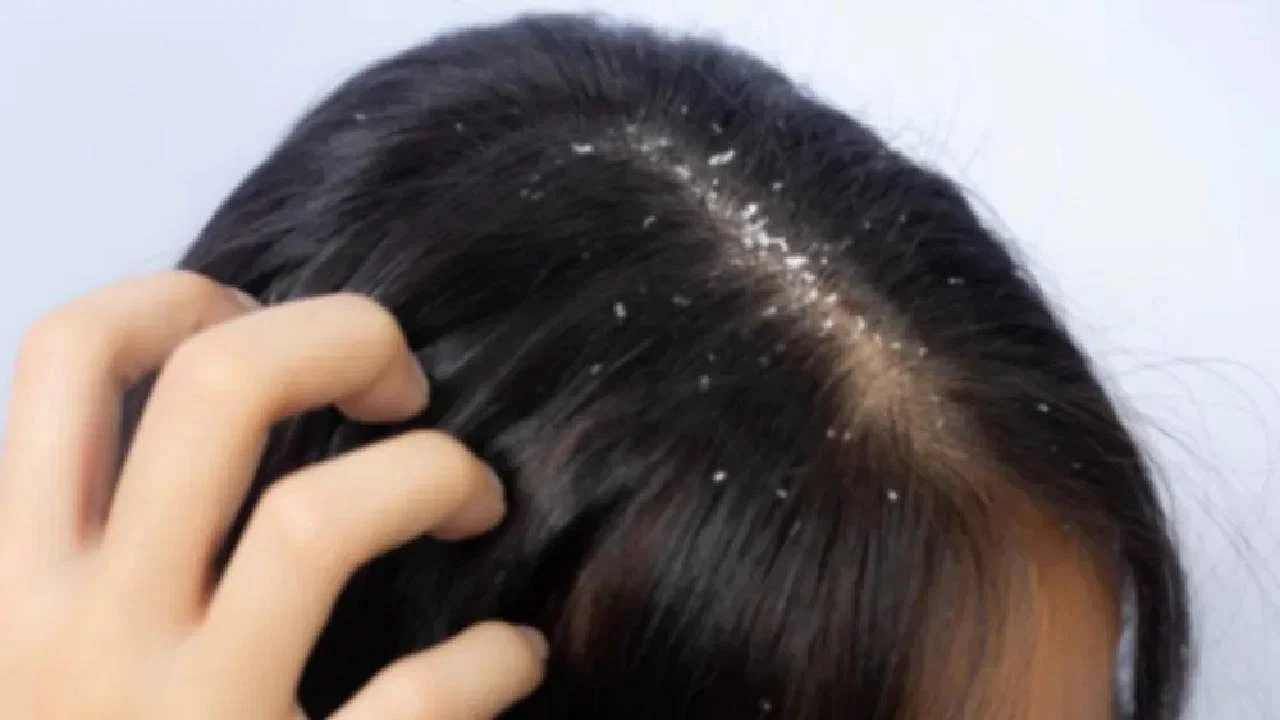 Remedies For Dandruff: ಚಳಿಗಾಲದಲ್ಲಿ ಕಾಡುವ ತಲೆಹೊಟ್ಟಿನ ಸಮಸ್ಯೆಗೆ ಇಲ್ಲಿದೆ ಸರಳ ಮನೆಮದ್ದುಗಳು