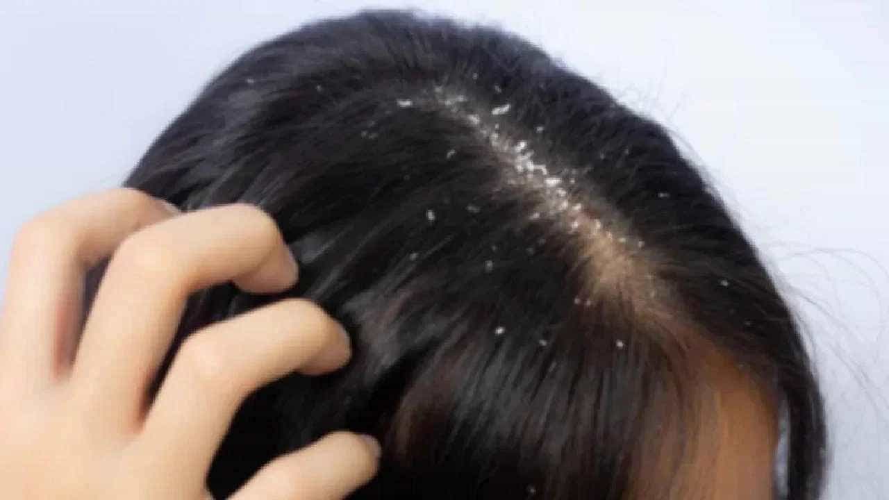 Remedies For Dandruff: ಚಳಿಗಾಲದಲ್ಲಿ ಕಾಡುವ ತಲೆಹೊಟ್ಟಿನ ಸಮಸ್ಯೆಗೆ ಇಲ್ಲಿದೆ ಸರಳ ಮನೆಮದ್ದುಗಳು Remedies For Dandruff: ಚಳಿಗಾಲದಲ್ಲಿ ಕಾಡುವ ತಲೆಹೊಟ್ಟಿನ ಸಮಸ್ಯೆಗೆ ಇಲ್ಲಿದೆ ಸರಳ ಮನೆಮದ್ದುಗಳು