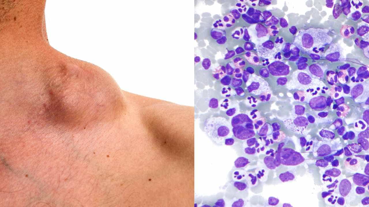 Hodgkin’s Lymphoma: ಹಾಜ್ಕಿನ್ ಲಿಂಫೋಮಾದಿಂದ ಬಳಲುತ್ತಿರುವ ಬಾಲಕಿಗೆ ಮಂಗಳೂರಿನಲ್ಲಿ ಯಶಸ್ವಿ ಶಸ್ತ್ರ ಚಿಕಿತ್ಸೆ, ಕಾಯಿಲೆ ಕುರಿತು ಮಾಹಿತಿ ಇಲ್ಲಿದೆ Hodgkin’s Lymphoma: ಹಾಜ್ಕಿನ್ ಲಿಂಫೋಮಾದಿಂದ ಬಳಲುತ್ತಿರುವ ಬಾಲಕಿಗೆ ಮಂಗಳೂರಿನಲ್ಲಿ ಯಶಸ್ವಿ ಶಸ್ತ್ರ ಚಿಕಿತ್ಸೆ, ಕಾಯಿಲೆ ಕುರಿತು ಮಾಹಿತಿ ಇಲ್ಲಿದೆ