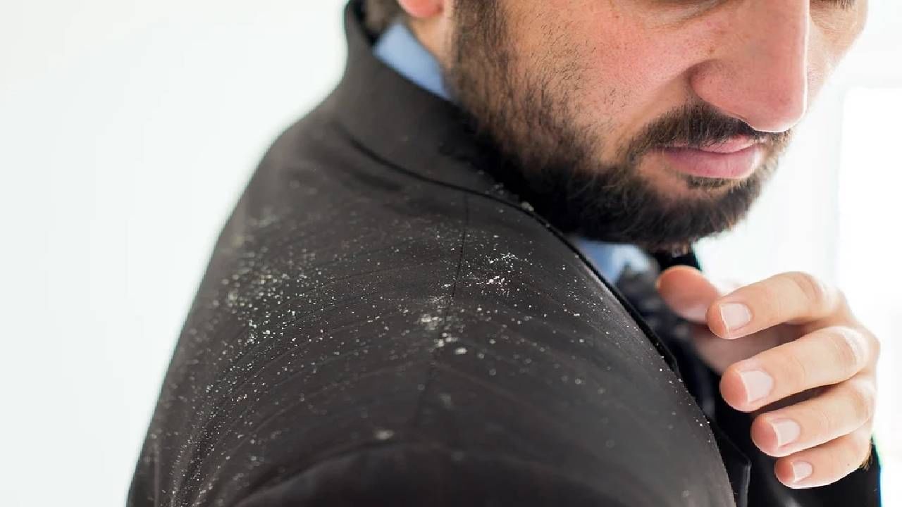 Remedies for Dandruff: ಈ ಮೂರು ಸಿಂಪಲ್​​​ ಟಿಪ್ಸ್​​ ನಿಮ್ಮ ತಲೆ ಹೊಟ್ಟು ಸಮಸ್ಯೆಯನ್ನು ಹೋಗಲಾಡಿಸುತ್ತದೆ