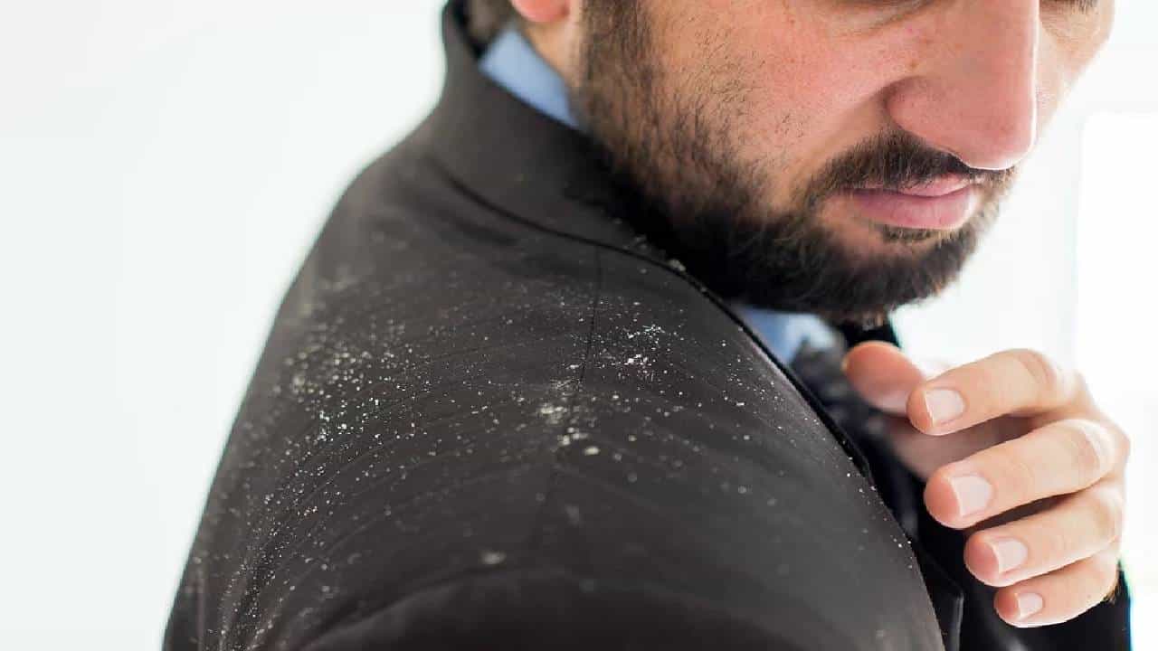 Remedies for Dandruff: ಈ ಮೂರು ಸಿಂಪಲ್ ಟಿಪ್ಸ್ ನಿಮ್ಮ ತಲೆ ಹೊಟ್ಟು ಸಮಸ್ಯೆಯನ್ನು ಹೋಗಲಾಡಿಸುತ್ತದೆ Remedies for Dandruff: ಈ ಮೂರು ಸಿಂಪಲ್ ಟಿಪ್ಸ್ ನಿಮ್ಮ ತಲೆ ಹೊಟ್ಟು ಸಮಸ್ಯೆಯನ್ನು ಹೋಗಲಾಡಿಸುತ್ತದೆ