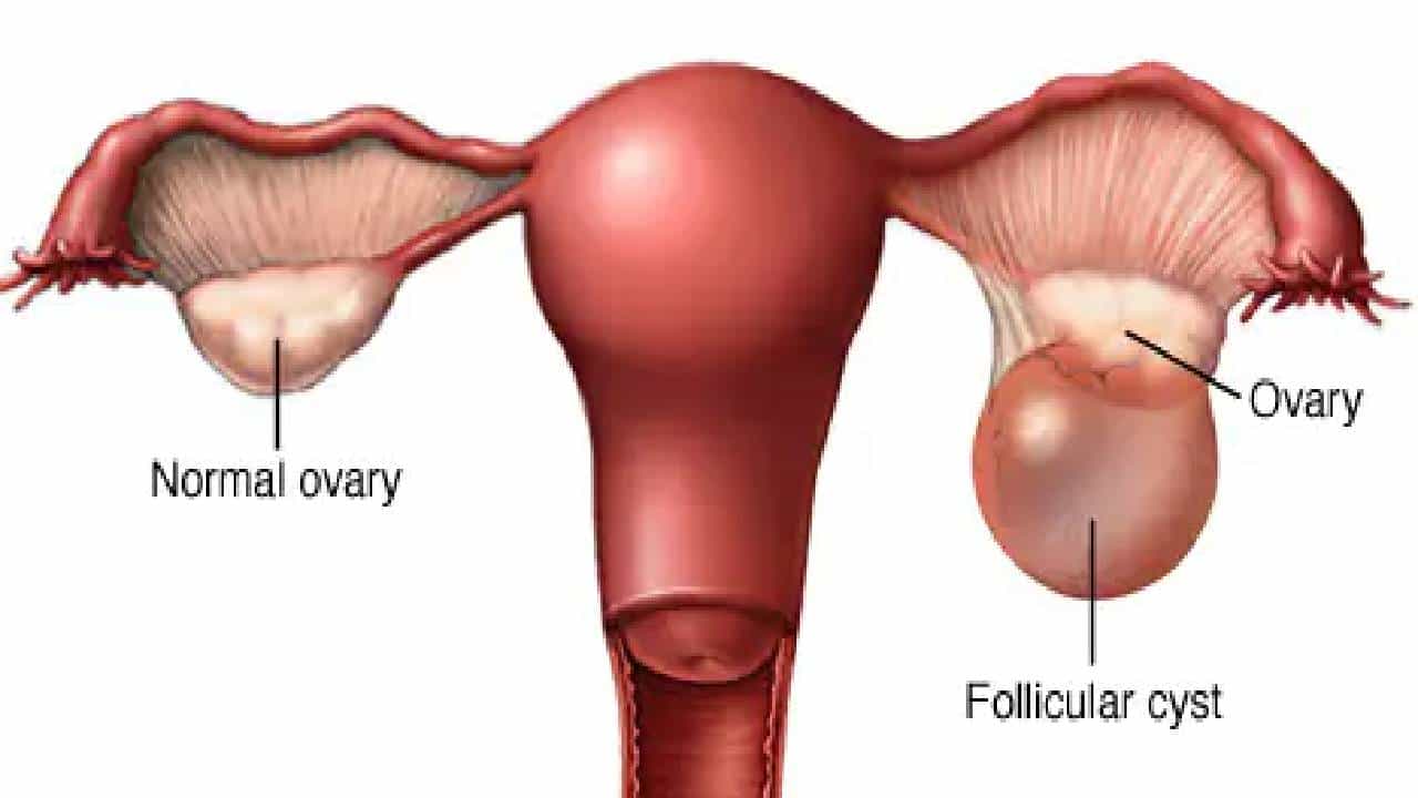 Women Health: ಮಹಿಳೆಯರಲ್ಲಿ ಅಂಡಾಶಯದ ಚೀಲಗಳು ಬೆಳೆಯಲು ಕಾರಣ ಹಾಗೂ ರೋಗಲಕ್ಷಣಗಳು