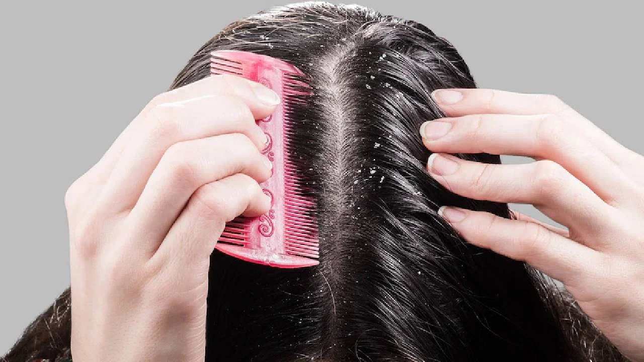 Dandruff Remedies: ಚಳಿಗಾಲದಲ್ಲಿ ತಲೆ ಹೊಟ್ಟಿನಿಂದ ಮುಕ್ತಿ ಪಡೆಯುವುದು ಹೇಗೆ?; ಇಲ್ಲಿವೆ ಮನೆಮದ್ದು Dandruff Remedies: ಚಳಿಗಾಲದಲ್ಲಿ ತಲೆ ಹೊಟ್ಟಿನಿಂದ ಮುಕ್ತಿ ಪಡೆಯುವುದು ಹೇಗೆ?; ಇಲ್ಲಿವೆ ಮನೆಮದ್ದು