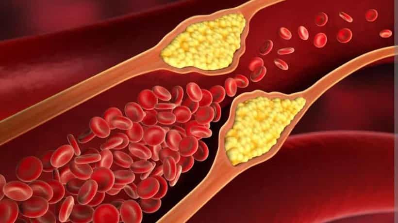 High Cholesterol: ಈ ಒಂದು ತರಕಾರಿ ಸೇವನೆಯಿಂದ ದೇಹದ ಕೊಬ್ಬನ್ನು ಕಡಿಮೆ ಮಾಡಬಹುದು