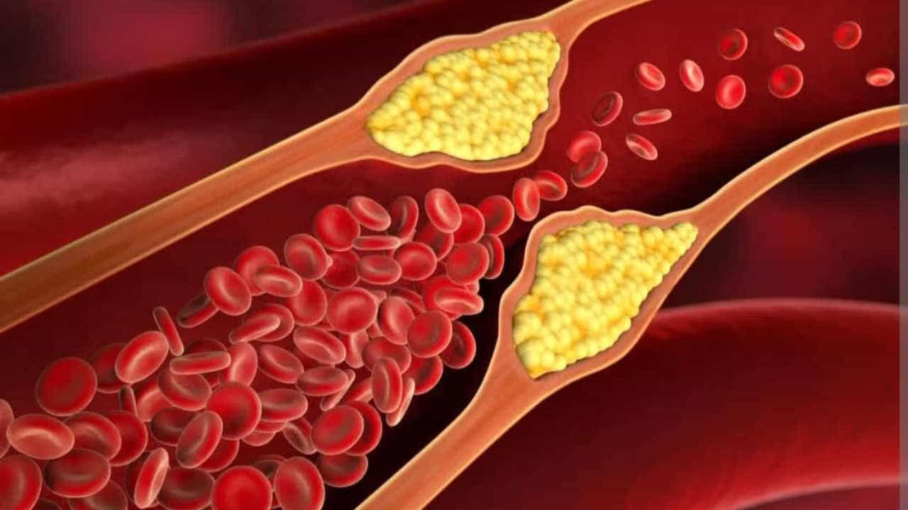 High Cholesterol: ಈ ಒಂದು ತರಕಾರಿ ಸೇವನೆಯಿಂದ ದೇಹದ ಕೊಬ್ಬನ್ನು ಕಡಿಮೆ ಮಾಡಬಹುದು High Cholesterol: ಈ ಒಂದು ತರಕಾರಿ ಸೇವನೆಯಿಂದ ದೇಹದ ಕೊಬ್ಬನ್ನು ಕಡಿಮೆ ಮಾಡಬಹುದು