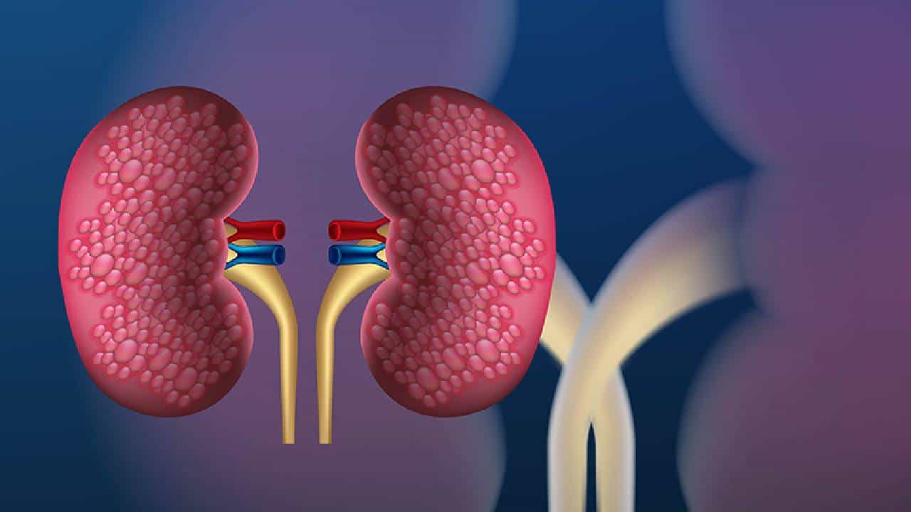 Diabetic Kidney Disease: ಮಧುಮೇಹ ಕಿಡ್ನಿ ಕಾಯಿಲೆಯ ಲಕ್ಷಣ ಮತ್ತು ಚಿಕಿತ್ಸೆಯ ಕುರಿತು ಮಾಹಿತಿ ಇಲ್ಲಿದೆ Diabetic Kidney Disease: ಮಧುಮೇಹ ಕಿಡ್ನಿ ಕಾಯಿಲೆಯ ಲಕ್ಷಣ ಮತ್ತು ಚಿಕಿತ್ಸೆಯ ಕುರಿತು ಮಾಹಿತಿ ಇಲ್ಲಿದೆ