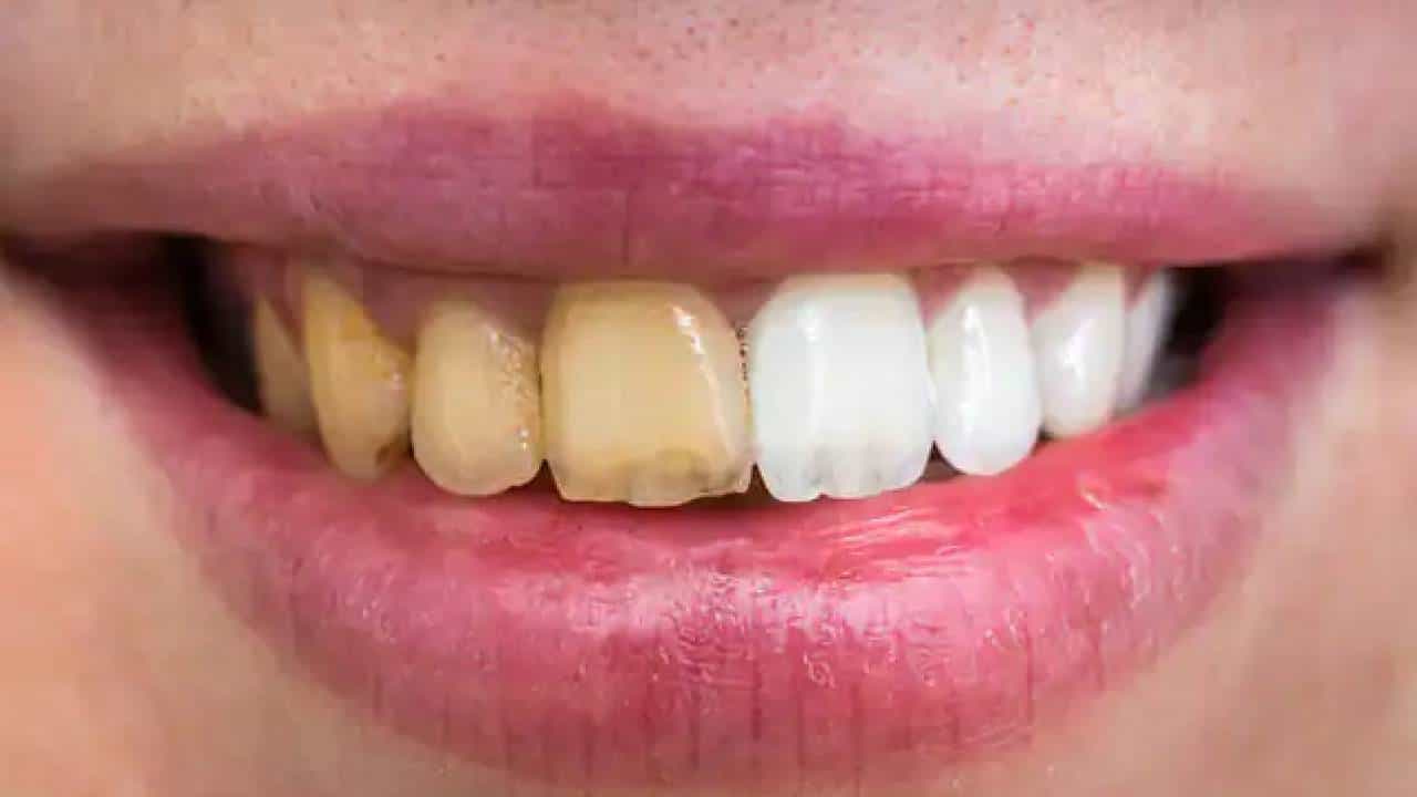Oral Hygiene: ನಿಮ್ಮ ಹಲ್ಲುಗಳ ಆರೋಗ್ಯಕ್ಕಾಗಿ ಈ ಅಭ್ಯಾಸವನ್ನು ರೂಢಿಸಿಕೊಳ್ಳಿ Oral Hygiene: ನಿಮ್ಮ ಹಲ್ಲುಗಳ ಆರೋಗ್ಯಕ್ಕಾಗಿ ಈ ಅಭ್ಯಾಸವನ್ನು ರೂಢಿಸಿಕೊಳ್ಳಿ