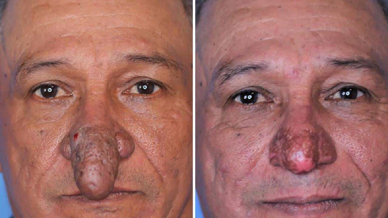 Rhinophyma :ರೈನೋಫಿಮಾ ಎಂದರೇನು ಮತ್ತು ಯಾವ ರೀತಿ ಗುಣಪಡಿಸಬಹುದು?