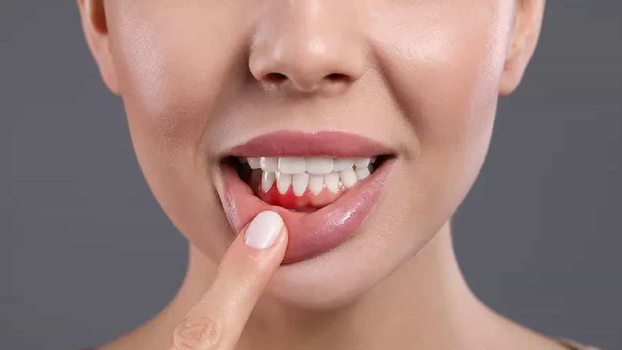 Bleeding Gums: ಅನಾರೋಗ್ಯಕರ ಒಸಡು ರಕ್ತಸ್ರಾವಕ್ಕೆ ಕಾರಣವಾಗಿರಬಹುದು; ಇಲ್ಲಿವೆ ನೀವು ಗಮನಿಸಬೇಕಾದ ಅಂಶಗಳು