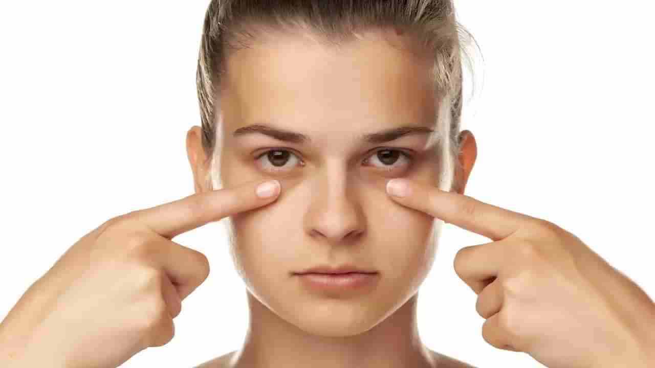 Dark Circles: ಡಾರ್ಕ್ ಸರ್ಕಲ್ಸ್​ ಬರಲು ಕಾರಣವೇನು? ಜೀವನಶೈಲಿಯೋ..ಅನುವಂಶಿಕ ಸಮಸ್ಯೆಯೋ?