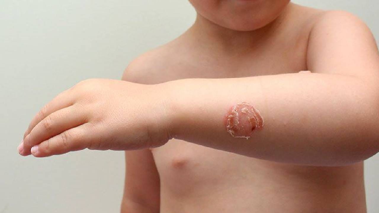 Impetigo : ಮಕ್ಕಳಲ್ಲಿ ಹೆಚ್ಚಾಗಿ ಕಂಡುಬರುವ ಚರ್ಮದ ಸಾಂಕ್ರಾಮಿಕ ಸೋಂಕಿಗೆ ಆರ್ಯುವೇದದ ಸಲಹೆ ಇಲ್ಲಿದೆ Impetigo : ಮಕ್ಕಳಲ್ಲಿ ಹೆಚ್ಚಾಗಿ ಕಂಡುಬರುವ ಚರ್ಮದ ಸಾಂಕ್ರಾಮಿಕ ಸೋಂಕಿಗೆ ಆರ್ಯುವೇದದ ಸಲಹೆ ಇಲ್ಲಿದೆ