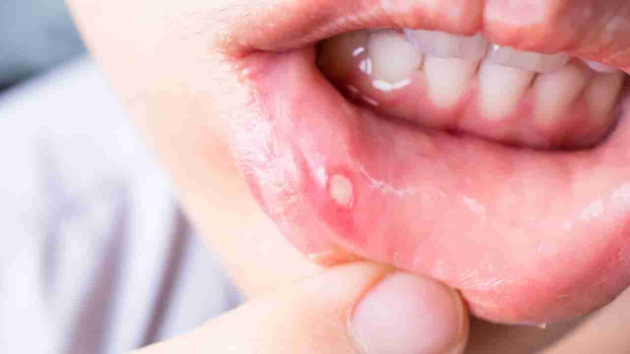 Mouth Ulcers: ಬಾಯಿ ಹುಣ್ಣು ಸಮಸ್ಯೆಗೆ ಈ ಆಹಾರಗಳು ಕಾರಣ