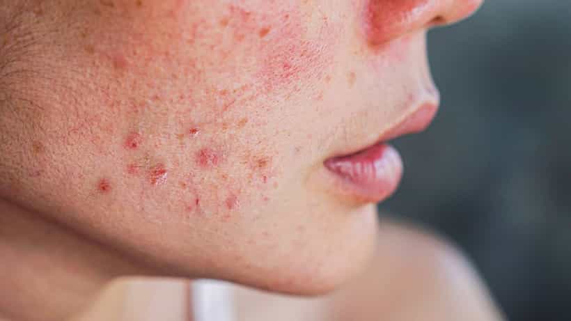 PCOD Acne: ಪಿಸಿಒಡಿ ಮೊಡವೆಗಳಿಂದ ಬೇಸತ್ತಿದ್ದೀರಾ? ಈ ತಜ್ಞರ ಆಹಾರ ಸಲಹೆಗಳು ನಿಮಗೆ ಸಹಾಯ ಮಾಡಬಹುದು