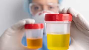 Urine Color: The color of urine tells about your health