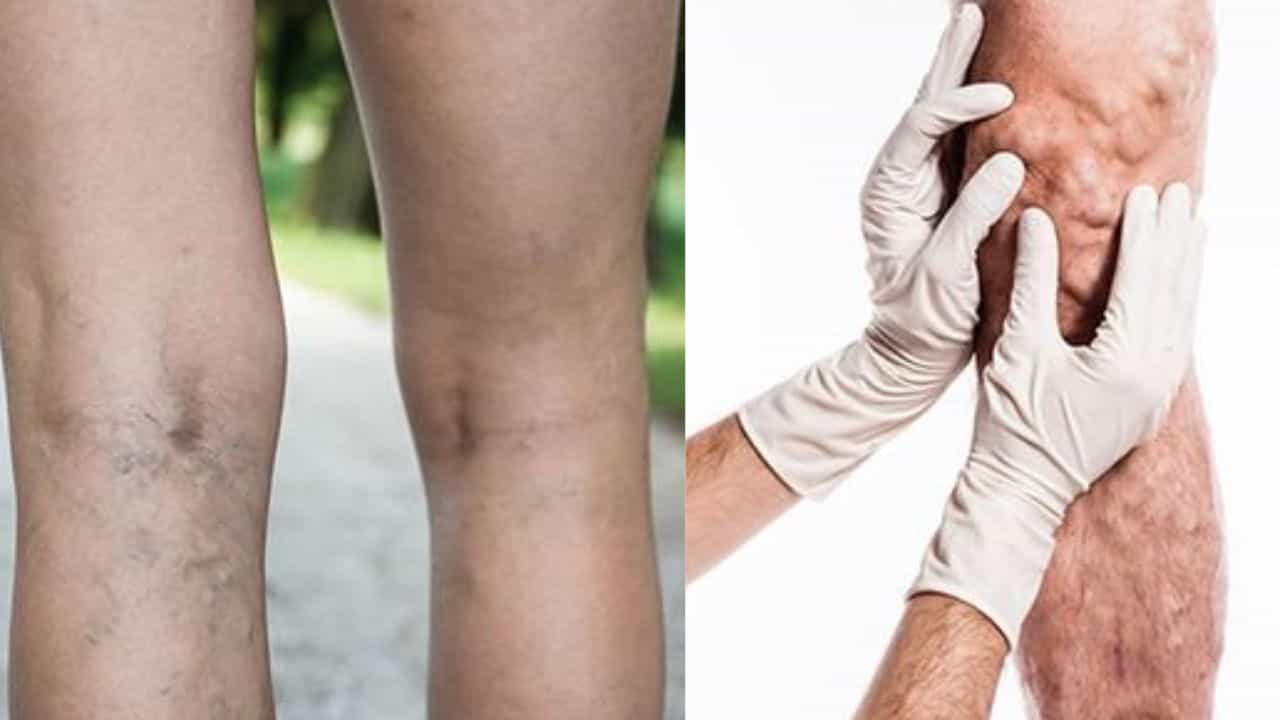 Endovenous Laser Ablation: ರಕ್ತನಾಳ ಉಬ್ಬುವಿಕೆಗೆ ಇವಿಎಲ್ಎ ಚಿಕಿತ್ಸೆ, ಎಲ್ಲೆಲ್ಲಿ ಚಿಕಿತ್ಸೆ ಲಭ್ಯ, ಇಲ್ಲಿದೆ ಮಾಹಿತಿ Endovenous Laser Ablation: ರಕ್ತನಾಳ ಉಬ್ಬುವಿಕೆಗೆ ಇವಿಎಲ್ಎ ಚಿಕಿತ್ಸೆ, ಎಲ್ಲೆಲ್ಲಿ ಚಿಕಿತ್ಸೆ ಲಭ್ಯ, ಇಲ್ಲಿದೆ ಮಾಹಿತಿ