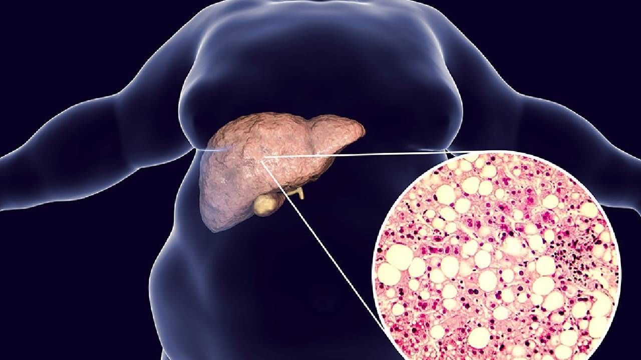 Non-alcoholic Fatty Liver Disease: ಸಾರಾಯಿ ಕುಡಿಯದಿದ್ದರೂ ಯಕೃತ್ತು ಕೆಡಬಹುದು..ಕಾರಣ ಇಲ್ಲಿದೆ ನೋಡಿ